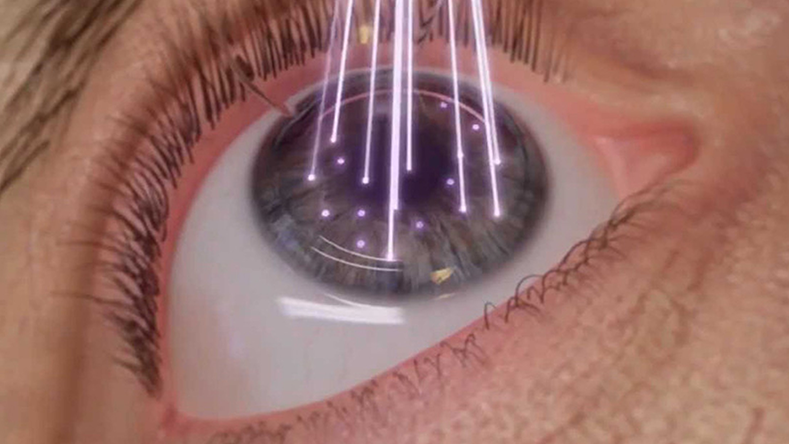 Close-up of an eye receiving laser treatment.